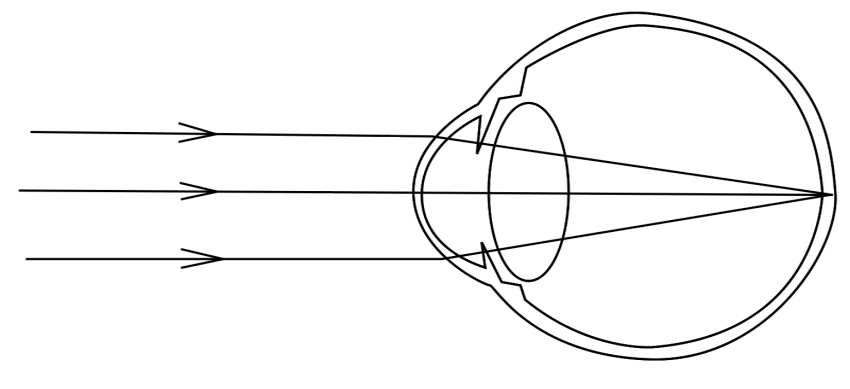 Emetropi ve Ametropi Nedir?