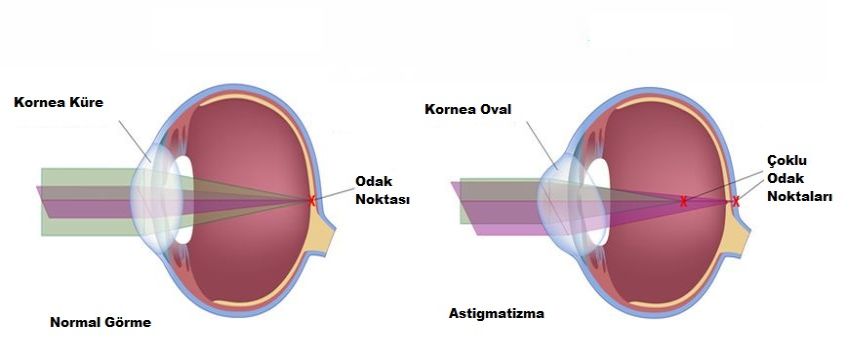 Astigmatizma Nedir?